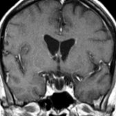 Coronal T1 C+ MR shows the enhancing infundibular stalk and pituitary gland  . This configuration with the stalk in the midline and a curvilinear pituitary gland has been called the anchor sign because of its resemblance to a ship's anchor  .