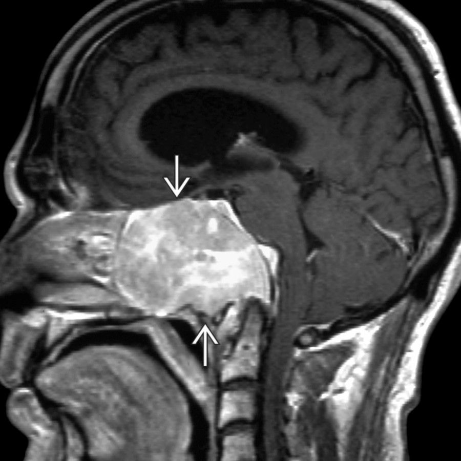 Sagittal T1 C+ MR shows a variant MR case of an unusually large skull base plasmacytoma  engulfing the clivus and extending into the nasopharynx and abutting C1-C2.