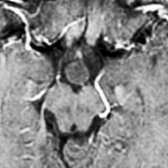 Axial T1 C+ MR reveals nonenhancing hamartoma  in the suprasellar cistern.