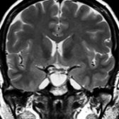 Coronal T2 MR in the same patient shows the expanded sella has a thin rim of compressed pituitary gland lining the sellar floor . The sella is filled with CSF exactly the same signal intensity as the fluid in Meckel caves and lateral ventricles. The diagnosis was primary ES.