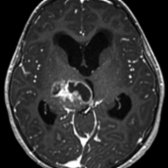 Axial T1 C+ MR shows a heterogeneous enhancing mass in the left thalamus . This was an H3 K27-mutant diffuse midline glioma. These have poor prognosis and are located in the thalami, brainstem, and spinal cord.