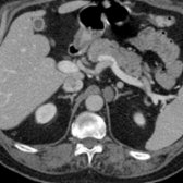 Axial CECT of a 62-year-old man shows a 2-cm, incidental left suprarenal lesion . Location adjacent to the left crus   and separate from the left adrenal  indicates a retroperitoneal bronchogenic cyst, a mimic of adrenal cyst.