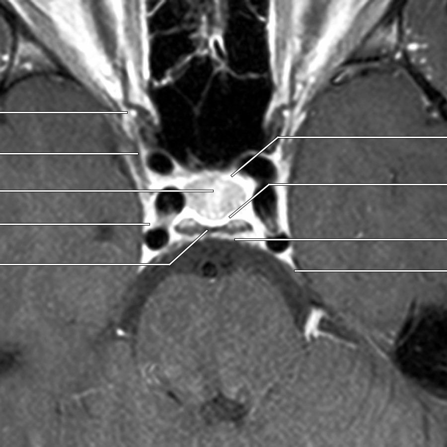 Cranial nerves exiting the CS through the superior orbital fissure (SOF) are CNIII, CNIV, CNVI, and the 1st (ophthalmic or V1) division of CNV.
