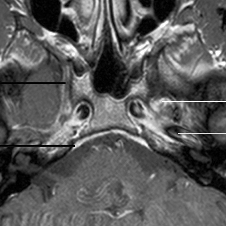 Series of 6 axial contrast-enhanced T1 MR images, presented from inferior to superior through the skull base and CS, demonstrates the right maxillary nerve (V2) passing anteriorly into the foramen rotundum and the left trigeminal ganglion. The mandibular nerve (V3) will exit inferiorly through the foramen ovale (not shown).