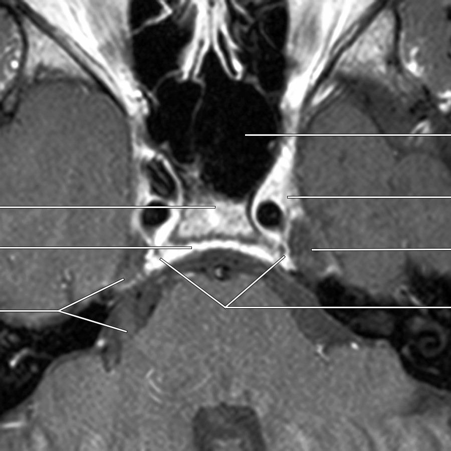 Both abducens nerves are seen coursing through the Dorello canal to enter the posterior CS. The right trigeminal nerve is seen entering the Meckel cave.