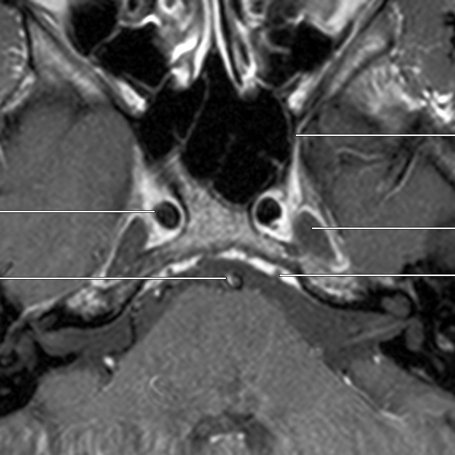 The Meckel cave is located posterior, inferior, and lateral relative to the CS. Dura forming the posterior part of the lateral wall of the CS also forms the upper medial 1/3 of the Meckel cave, separating the 2 structures. Note the abducens nerve (CNVI) seen here as a filling defect within the clival venous plexus, just before entering the Dorello canal.