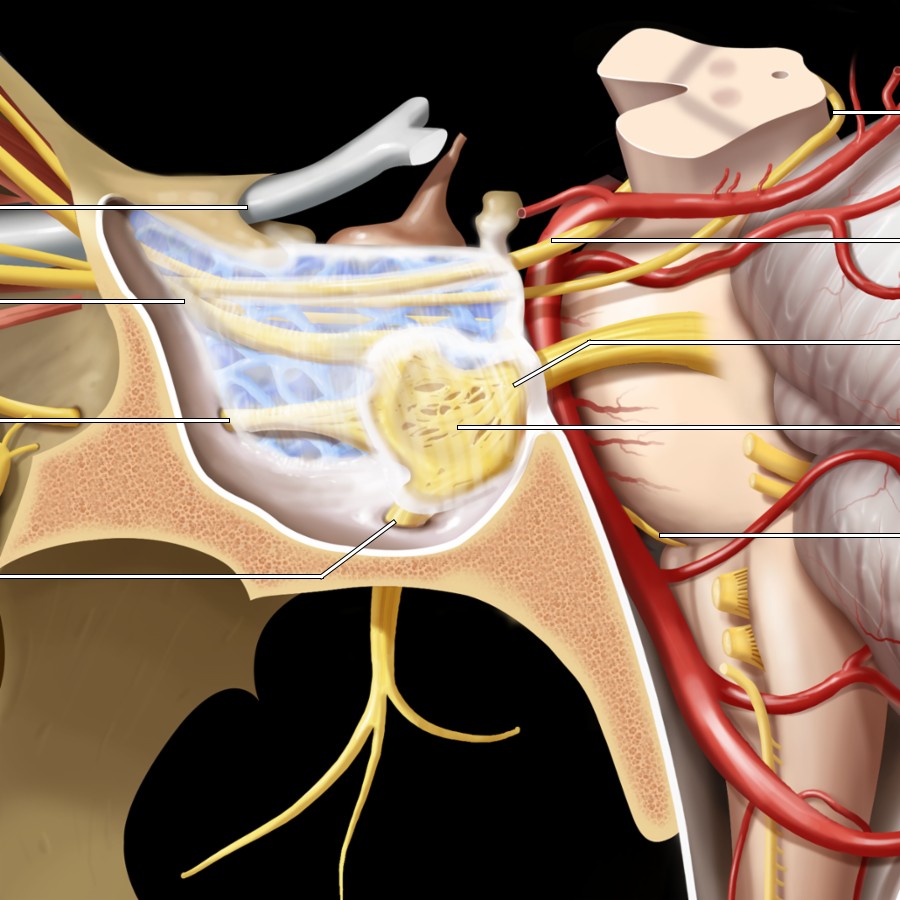 Lateral graphic demonstrates cranial nerve detail in sellar region. CNIII, CNIV, CNV1, and CNV2 are in lateral dural wall of CS. CNVI courses within venous sinusoids of CS, adjacent to internal carotid artery (not shown). Meckel cave is CSF-filled, dural and arachnoid-lined invagination that communicates freely with prepontine cistern. It contains fascicles of trigeminal nerve (CNV) and trigeminal (gasserian) ganglion.