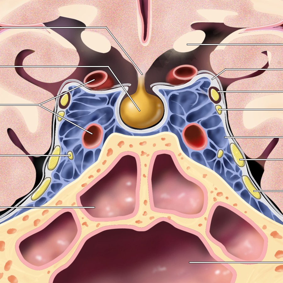 Coronal graphic depicts contents of CSs. The following cranial nerves traverse CS within lateral wall of CS, from superior to inferior: Oculomotor (CNIII), trochlear (CNIV), 1st (ophthalmic or V1) and 2nd (maxillary or V2) divisions of trigeminal (CNV) nerves. The only cranial nerve actually within venous sinusoids of CS is abducens nerve (CNVI).