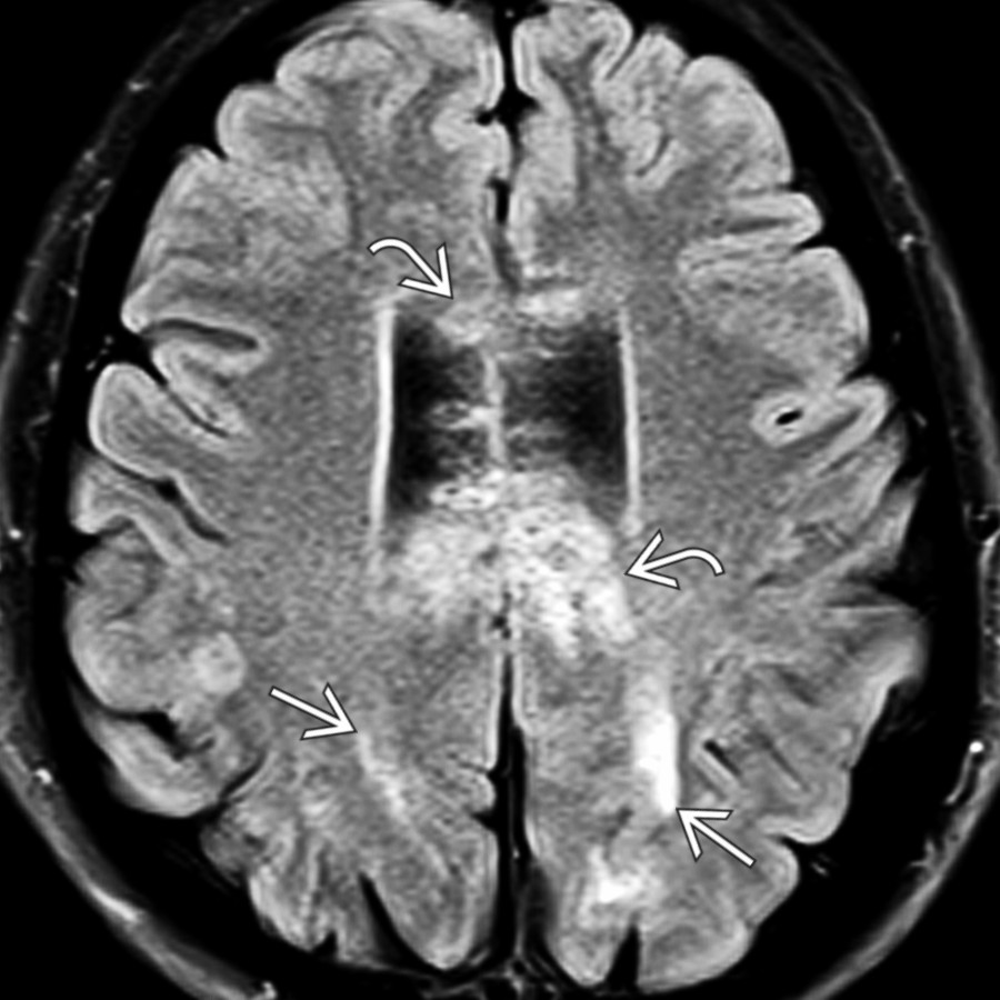 Axial FLAIR MR in a 28-year-old man with rapidly declining mental status after a flu-like illness shows patchy hyperintensities in the corpus callosum
and deep/subcortical WM
.