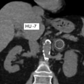 Coronal NECT in the same patient shows low attenuation of the left adrenal mass
(HU -7). Noncontrast attenuation of HU < 10 is consistent with adrenal adenoma.