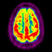 Axial F-18 FDG PET shows findings associated with frontotemporal dementia (FTD), predominantly frontal
and temporal lobe hypometabolism. Functional changes may occur prior to CT or MR changes.