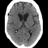 Axial NECT in same SCA1 patient shows atrophy of the caudate nuclei bilaterally with convex margins of the frontal horns (boxcar appearance) due to atrophy of the caudate heads
. Huntington disease, neuroacanthocytosis, and frontotemporal lobar degeneration with fused in sarcoma protein (FTLD-FUS) can also produce this appearance.