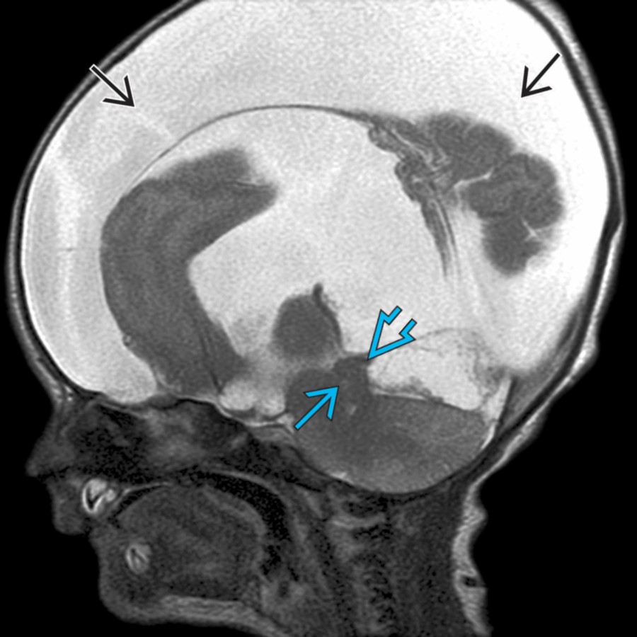 Sagittal T2WI MR of a neonate with severe congenital hydrocephalus, imaged on the 1st day of life, shows severe aqueductal stenosis
and abnormal dysplastic tectal thickening
. Severe congenital hydrocephalus has resulted in spontaneous decompression into the subdural spaces
.
