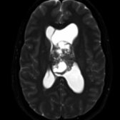 Axial T2 MR shows a heterogeneous, partially cystic mass along the left septum pellucidum
. This is a classic location of a central neurocytoma with a bubbly, cystic appearance.