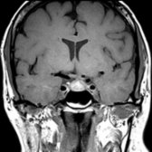 Coronal T1 MR in a 48-year-old man with headache shows a hyperintense, sellar mass
with normal surrounding pituitary tissue.