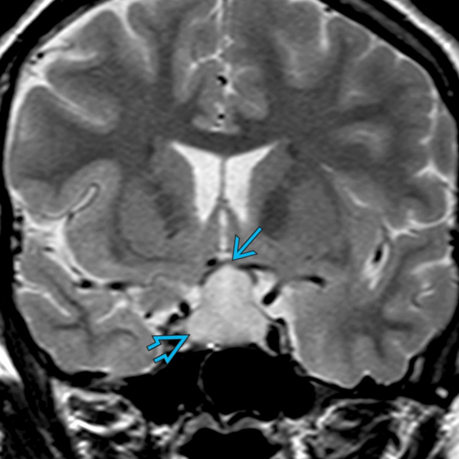 Coronal T2 MR in a pregnant patient with acute vision problems shows a sellar and suprasellar mass
with superior displacement of the optic chiasm
. Imaging of lymphocytic hypophysitis may mimic a pituitary macroadenoma.