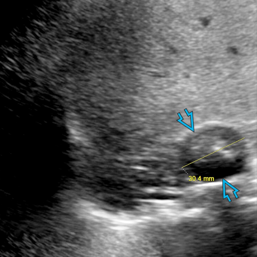 Longitudinal transabdominal ultrasound demonstrates well-circumscribed, round, heterogeneous, hypoechoic mass
in the right suprarenal region medially, proven to be a paraganglioma.