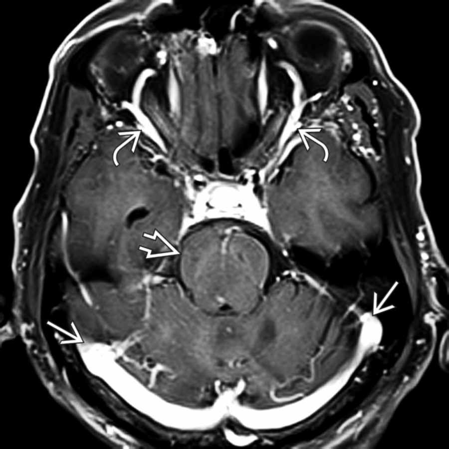 Axial T1 C+ FS MR in the same patient shows a "fat" midbrain/pons
, prominent superior ophthalmic veins
, and engorged, outwardly convex transverse/sigmoid sinuses
. No subdural hematomas were identified. Severe IH was treated successfully with a blood patch.
