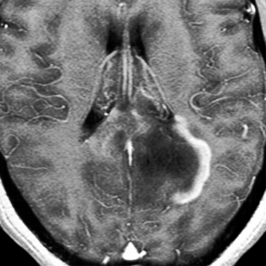 Axial T1 C+ MR shows irregular, thick partial ring enhancement around a mass-like lesion in a patient not previously diagnosed with MS. This was biopsy-proven tumefactive MS. (Courtesy M. Mirfakharee, MD.)