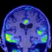 Coronal fused tau PET/MR in the same patient shows additional cortical binding in the lateral temporal lobes
and cingulate gyrus
.