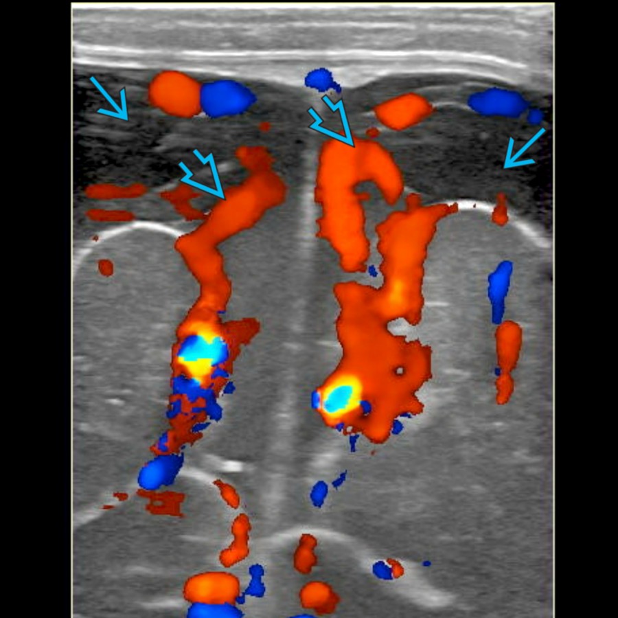 Coronal color Doppler US in a 9-month-old with BESS shows normal vessels
coursing through prominent fluid
, an expected finding that helps differentiate the SAS from subdural collections.