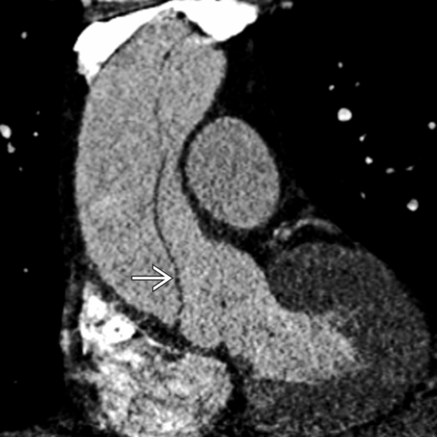 Double oblique CECT shows dilation of the ascending aorta in a hypertensive patient presenting with anterior chest pain. Note the intimal flap
. This patient was treated with emergent surgery.