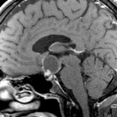 Sagittal T1 C+ MR in a 48-year-old man with visual changes shows an enhancing nodule
, which distinguishes this cystic lesion as a craniopharyngioma, not a Rathke cleft cyst. Surgical resection is the primary therapy for this WHO grade 1 neoplasm; however, the recurrence rate at 10 years approaches 20%.