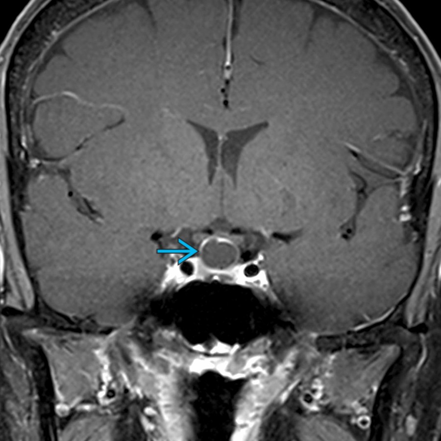 Coronal T1 C+ MR in a 62-year-old woman with headaches shows a cystic suprasellar mass
with mild peripheral enhancement, a claw sign related to compression of the adjacent normal pituitary gland by the Rathke cleft cyst. Note the lack of enhancement within the cyst.