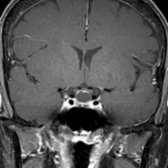 Coronal T1 C+ MR in a 62-year-old woman with headaches shows a cystic suprasellar mass
with mild peripheral enhancement, a claw sign related to compression of the adjacent normal pituitary gland by the Rathke cleft cyst. Note the lack of enhancement within the cyst.