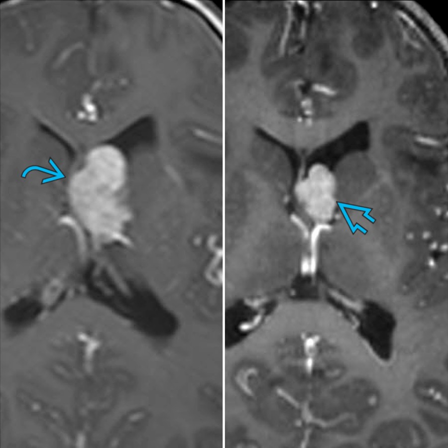 Axial T1 C+ MR in a 4-year-old girl shows a large SEGA
in the left caudothalamic groove (left). Three months after initiation of an mTOR inhibitor (right), the SEGA
has substantially decreased in size. mTOR inhibitors are often used as 1st-line therapy for symptomatic SEGAs & have secondary benefits of decreased seizure frequency.