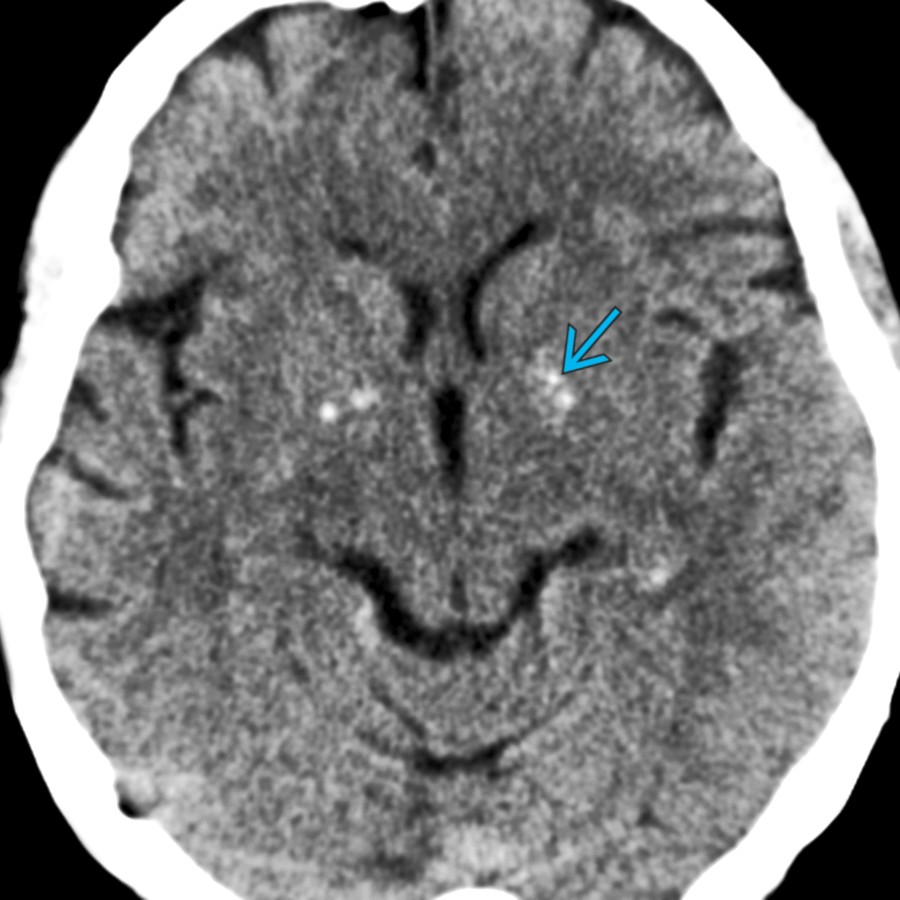 Axial NECT shows typical basal ganglia (BG) Ca⁺⁺ in this 75-year-old man who presented after minor trauma. Note the location within the globus pallidus (GP)
, typical for normal aging brain. Physiologic Ca⁺⁺ is typically seen in adults over 30 years.