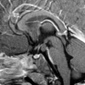 Sagittal T1WI C+ MR in the same patient shows the mass
does not enhance. This is a classic pedunculated HH. If the lesion enhanced, considerations would include hypothalamic astrocytoma, Langerhans cell histiocytosis, and germ cell tumor.