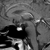 Sagittal T1 C+ MR shows a prominent pituitary gland
in a 37-year-old man with panhypopituitarism during treatment with ipilimumab for metastatic melanoma. The gland had doubled in size since MR 6 weeks prior. This drug-induced LH was related to a cancer immunotherapy.
