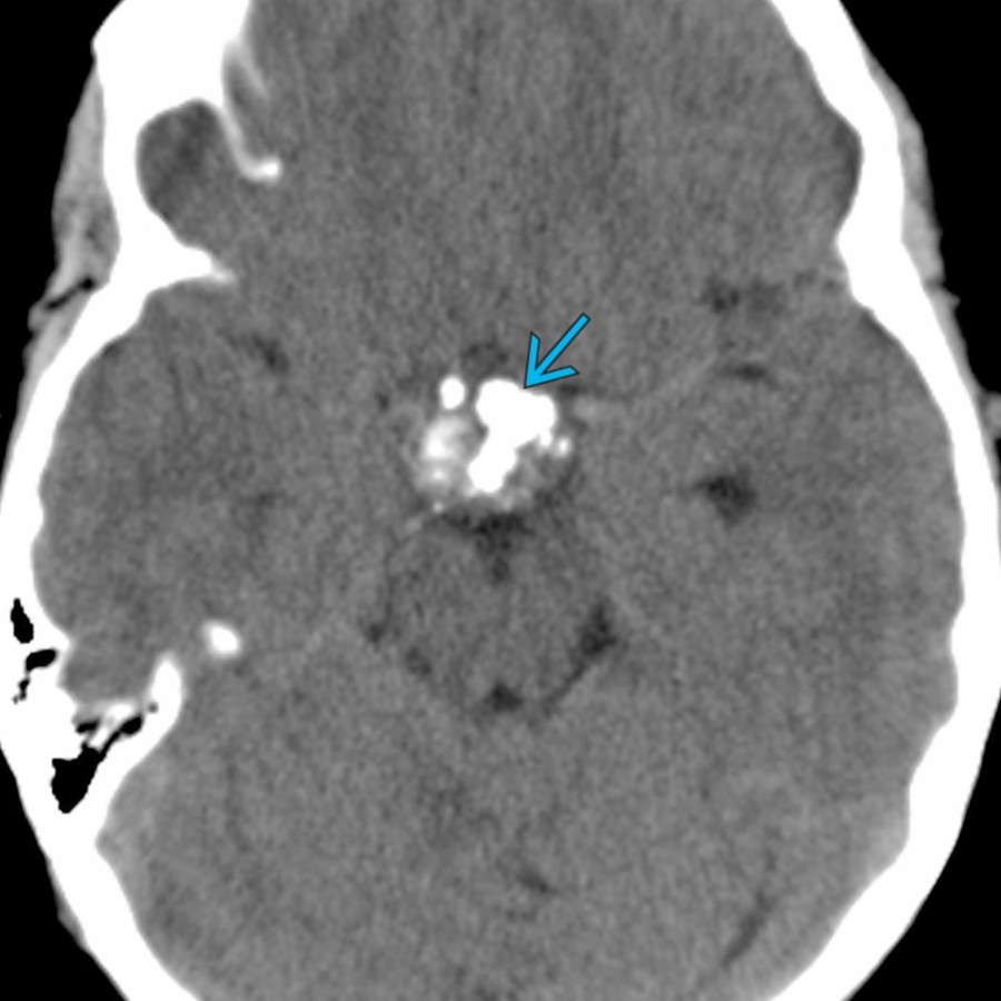 Axial NECT shows a cystic suprasellar mass with globular calcifications
typical of an adamantinomatous craniopharyngioma. These tumors are WHO grade 1 and are typically treated with surgical resection.