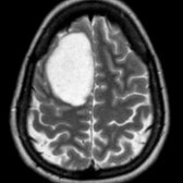 Axial T2 MR shows a well-circumscribed, peripheral, homogeneously T2-hyperintense mass
in the right frontal lobe involving both the cortex and subcortical white matter. The frontal lobe is the most common location for oligodendrogliomas.