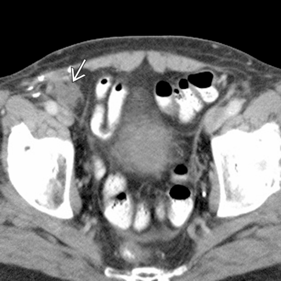 Axial CECT demonstrates the characteristic appearance of a mesh plug
utilized for inguinal hernia repair. This is a characteristic appearance and location, which should not be confused for an abnormal lymph node or mass.