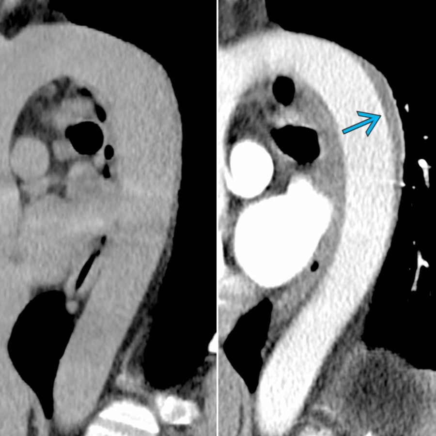 Sagittal reformat CECT in a patient with GCA before and after contrast shows focal parietal thickening along the posterior descending thoracic aorta, only evident on CECT
. Typically, vasculitis is not hyperdense on NECT as opposed to intramural hematoma.