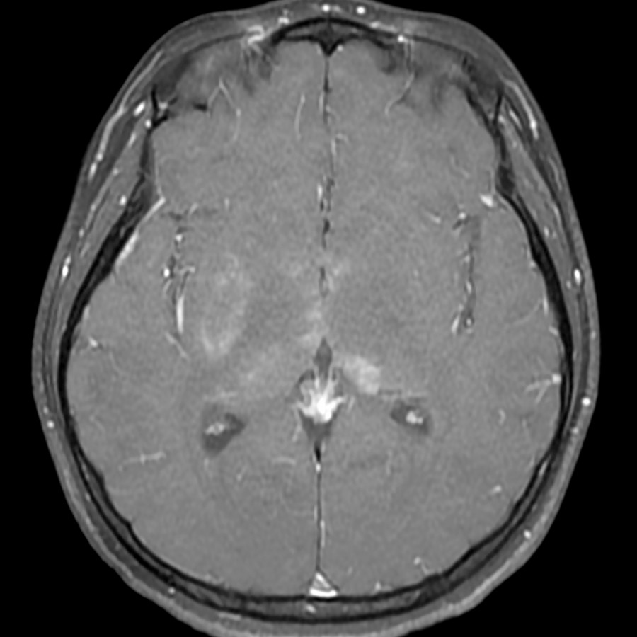 Axial T1 C+ FS MR in the same patient shows patchy enhancement of the thalamic, basal ganglia, and hypothalamic lesions. In this patient, the hypothalamic lesions are conspicuous on contrast imaging but subtle on noncontrast FLAIR MR.