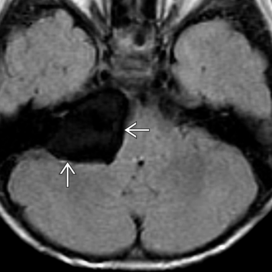 Axial FLAIR MR in the same patient demonstrates complete attenuation of signal intensity within the cyst
, typical of an arachnoid cyst. There was no diffusion restriction on DW images (not shown), unlike an epidermoid cyst, which typically demonstrates diffusion restriction.