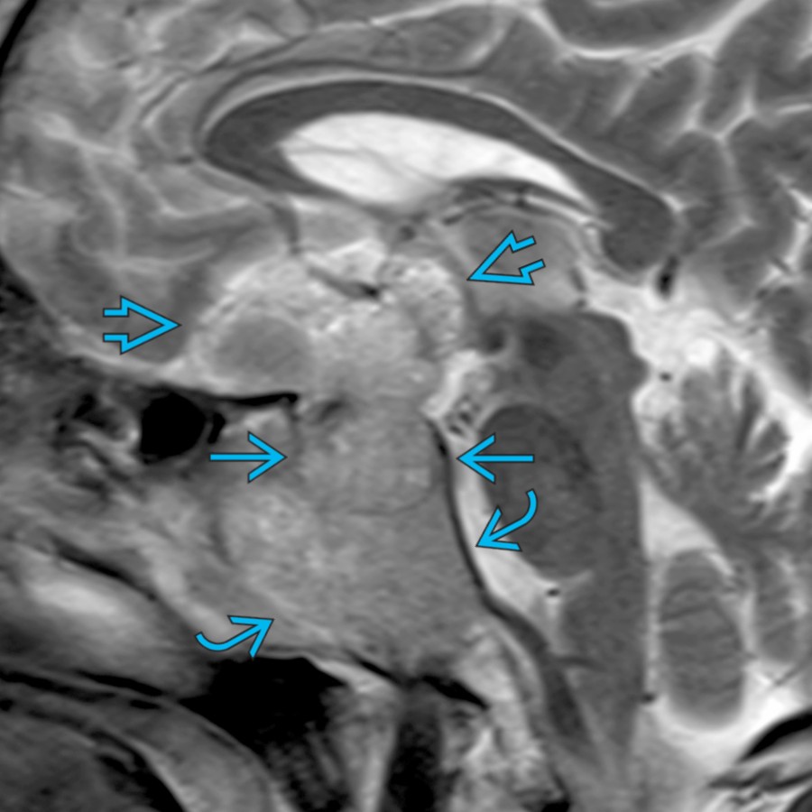 Sagittal T2 MR shows a heterogeneous mass indistinguishable from the pituitary gland, which expands the sella
with suprasellar extension
and skull base invasion
.