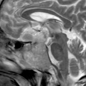 Sagittal T2 MR shows a heterogeneous mass indistinguishable from the pituitary gland, which expands the sella
with suprasellar extension
and skull base invasion
.
