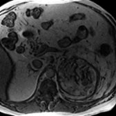 Axial out-of-phase MR in the same patient shows a low-signal rim
(due to hemosiderin) and perinephric infiltration. Most myelolipomas are asymptomatic, but larger tumors may hemorrhage, as in this case. Adrenalectomy was performed given the large size of the tumor and evidence of repeated hemorrhage.