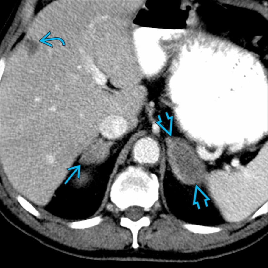 Axial CECT in the same patient confirms the left adrenal mass
, along with right adrenal mass
and a liver lesion
, confirmed lung cancer metastases.