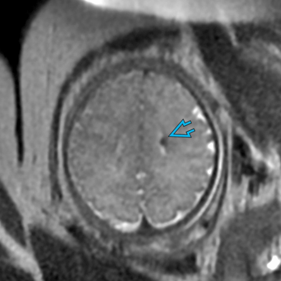 Axial T2 MR SSFSE of a 36-weeks gestation fetus shows a hypointense subependymal nodule
. Other non-CNS features confirmed a diagnosis of TSC.