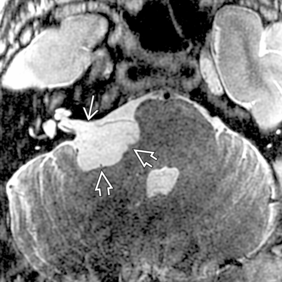 Axial T2 MR demonstrates a right CPA cistern epidermoid cyst with penetration of the porus acusticus
and lobulated mass effect on the lateral margin of the brachium pontis
.