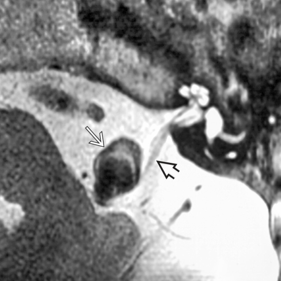 Axial T2WI MR shows a CPA vertebral artery aneurysm as an ovoid mass
with complex wall signal, which bows the vestibulocochlear nerve
posterolaterally.
