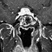 Coronal T1 C+ MR shows LH. Note that the mass enhances strongly and uniformly. The imaging appearance is indistinguishable from that of macroadenoma.