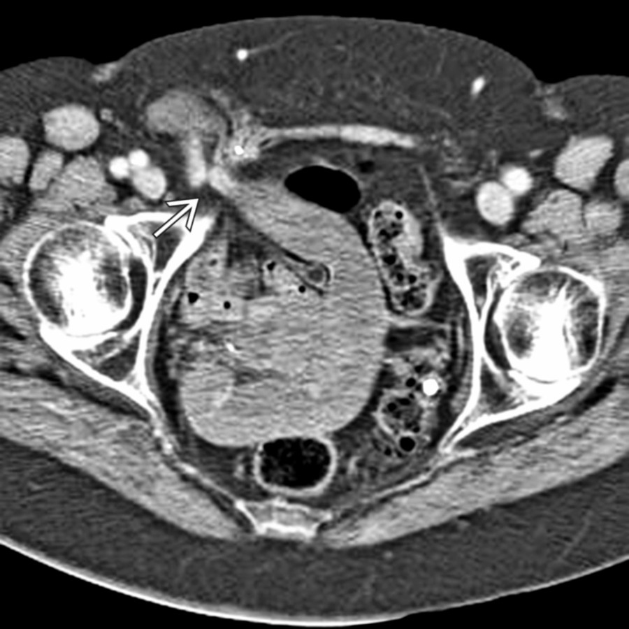 Axial CECT shows a dilated small bowel entering the inguinal canal and the leaving collapsed bowel
.