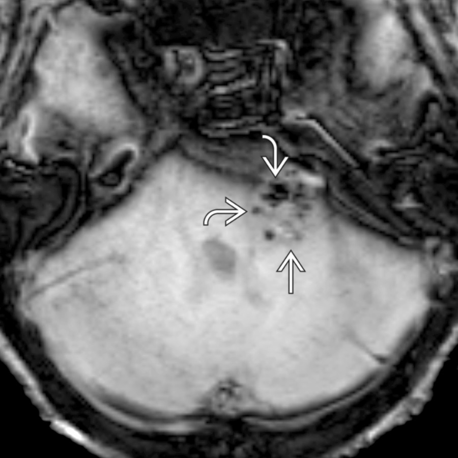 Axial SWI MR in a CPA-IAC vestibular schwannoma
shows punctate foci of gradient susceptibility
from microhemorrhage, a feature that can help distinguish CPA-IAC schwannoma from meningioma.