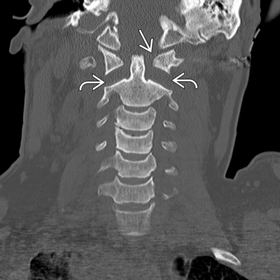Coronal CT shows the disrupted spinal articulations at C1-C2 (atlantoaxial dissociation). There is widening of the atlantoodontoid articulation
and widening/dislocation of the lateral masses of C1 and C2
.